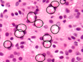 Spironolactone bodies. Attribution-Share Alike 3.0 Unported licensing, attributed to Nephron and Mikael Häggström