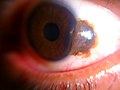 Conjunctival nevus of a 32-year-old male