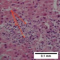 Micrograph of an infarct in the biliary tract, with pyknotic nuclei (arrows) (400x).