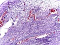 Micrograph of appendicitis showing neutrophils in the muscularis propria. H&E stain