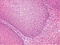 High magnification. There is prominent acanthosis. The tumor front is broad-based and pushes the subepithelial tissues.[10]