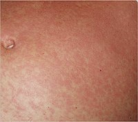 Typical fine-spotted pink rash of acute African trypanosomiasis on the skin of the abdomen ("trypanid rash")[14]