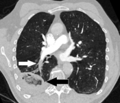 Pulmonary embolism (white arrow) that has been long-standing and has caused a lung infarction (black arrow) seen as a reverse halo sign.