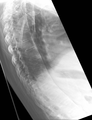 Lateral X-ray of the mid back in ankylosing spondylitis