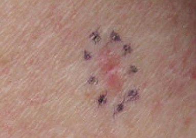 Basal cell carcinoma on the left upper back, nodular and micronodular, marked for biopsy
