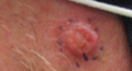 Squamous Cell Carcinoma, Right Upper Cheek; Lesion outlined in blue marker with a dashed line prior to biopsy