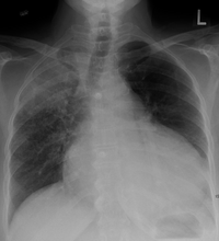 Pericardial effusion due to malignancy. Note bulbous heart and primary lung cancer in right upper lobe.