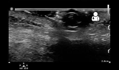 Ultrasound showing maggot infestation[24]