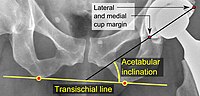 Acetabular inclination of a hip prosthesis
