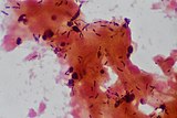Candida spores in a vaginal swab. (Gram stain)