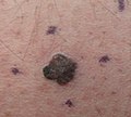 Melanoma, right medial thigh marked for biopsy
