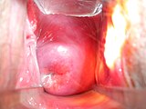 Äußerer Muttermund (Portio vaginalis uteri) und hinteres Ende der Vagina einer stillenden Frau nach zwei Geburten, Para 2, Blick durch ein Spekulum.