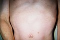 Torso of thirty-seven-year-old, second-generation patient, exhibiting lentiginosis.