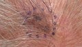Melanoma in situ, vertex scalp marked for biopsy