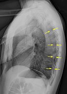Lateral inspired X-ray at the same time, more clearly showing the pneumothorax posteriorly in this case
