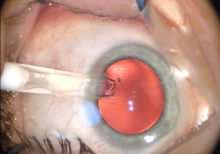 The tip of the nozzle can be seen penetrating the incision above a widely dilated pupil