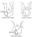 Different types of inguinal hernias.