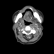 Einseitige Zungenatrophie bei Hypoglossusparese links (rechts normal [X]; CT-Bild)