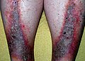 Stasis dermatitis (Gravitational eczema)
