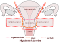 Schematische Darstellung der Ausdehnung unterschiedlicher Formen der Hysterektomie