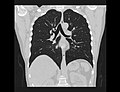 Chest CT (coronal lung window)