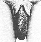 Hypertrophie der inneren Schamlippen bei einer Frau der Khoisan, in gespreiztem Zustand (links) und aufrecht stehend (rechts)