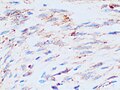 Immunohistochemistry for β-catenin in uterine leiomyoma, which is negative as there is only staining of cytoplasm but not of cell nuclei.