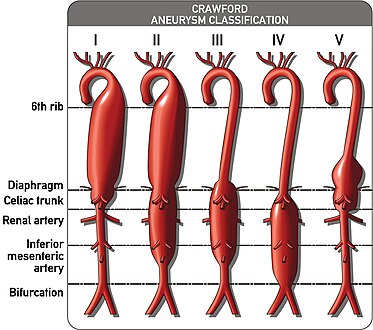 The Crawford Classification for thoracoabdominal aortic aneurysms is pictured above.