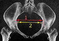 Low dose CT for pelvimetry