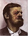 Lupus vulgaris in a man, c. 1900