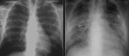 These chest radiographs are of two patients. Both show ground glass opacities. The left X-ray shows a much more subtle ground-glass appearance while the right X-ray shows a much more gross ground-glass appearance mimicking pulmonary edema.[7]
