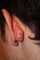 Posterior auricular keloid triggered by otoplasty surgery