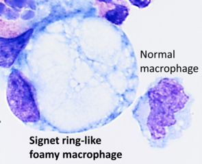 A signet ring-like foamy macrophage, which may mimic a cancer cell, but the texture of the nucleus is similar to that of a normal macrophage.