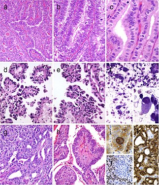 Columnar cell variant of papillary thyroid carcinoma (PTC) showing a combination of papillary and glandular-like patterns (a), marked nuclear pseudostratification, and less nuclear features of classic PTC (b). In the tall cell variant of PTC, the cytoplasm is deeply eosinophilic, and nuclear features of PTC are very prominent with irregular contours and common pseudoinclusions (c). Hobnail variant of PTC combining papillary (d), and micropapillary (e) structures lined by hobnail cells. “Teardrop” cells (f) and comet-like cells (inset). The cribriform-morular thyroid carcinoma exhibits a blending of cribriform, papillary, trabecular, and solid pattern with morules (g) and (h). Morules are strongly positive for CD10 (i). Tumor cells are reactive for estrogen receptors (j), and there is strong nuclear and cytoplasmic reactivity for β-catenin (k)[7]