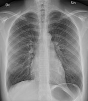 Normal chest radiograph, posteroanterior view