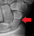 A more obvious scaphoid fracture on a scaphoid view X ray