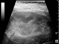 Renal ultrasonograph of acute pyelonephritis with increased cortical echogenicity and blurred delineation of the upper pole.[17]