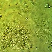 Vaginal wet mount with a clue cell indicating bacterial vaginosis