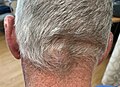 Epidermal inclusion cyst on the nape of a person's neck