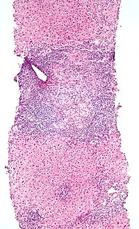 Low-magnification micrograph of PBC, H&E stain