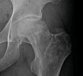 Radiography of avascular necrosis of left femoral head. Man of 45 years with AIDS.