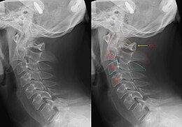 Two x-rays, showing the normal position of the neck, and then a typical break as it would be caused by a hangman's noose