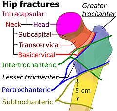 Hip fracture classification