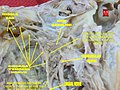 Dissection of chorda tympani nerve