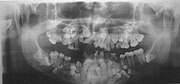 Panoramic view of the jaws showing multiple unerupted supernumerary teeth mimicking premolar, missing gonial angles and underdeveloped maxillary sinuses in cleidocranial dysplasia.