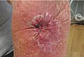 Melanoma left forearm post excision with purse-string closure