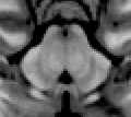 MRI section of mid-brain.