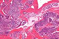 Micrograph showing endometrial stromal condensation, a finding seen in menses.