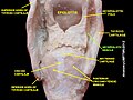 Aryepiglotic muscle