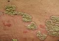 Plaques of psoriasis
